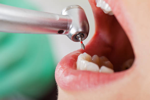 Best Cracked Tooth Emergency Dentist  in Gunbarrel, CO